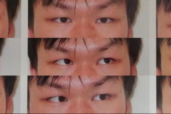 十年斜視伴重影困擾 南昌愛爾楊秋艷手術助青年重建雙眼視功能